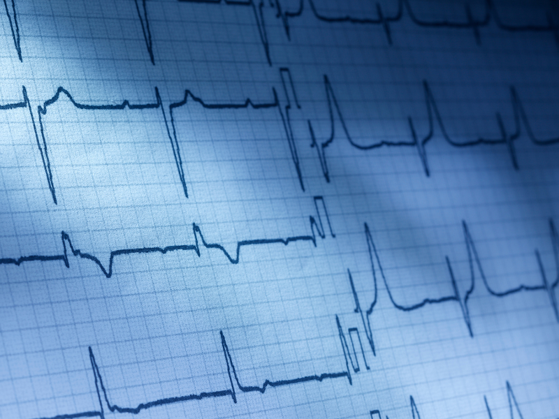 como fazer eletrocardiograma resultados