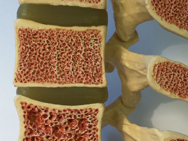 fisiopatologia osteoporose fatores