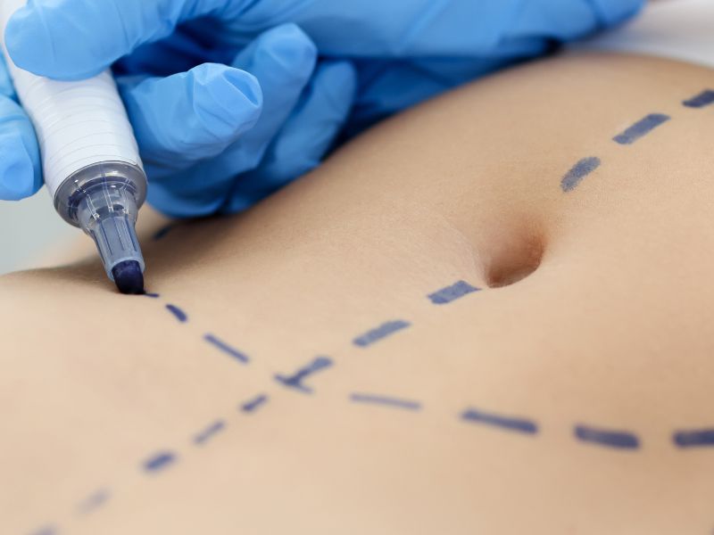 melhor clínica de abdominoplastia em São Paulo - preparação