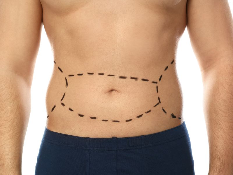 melhor clínica de abdominoplastia em São Paulo - momento ideal