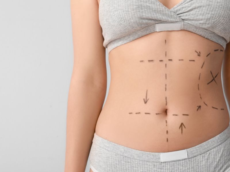 o que é abdominoplastia e quem deve considerar