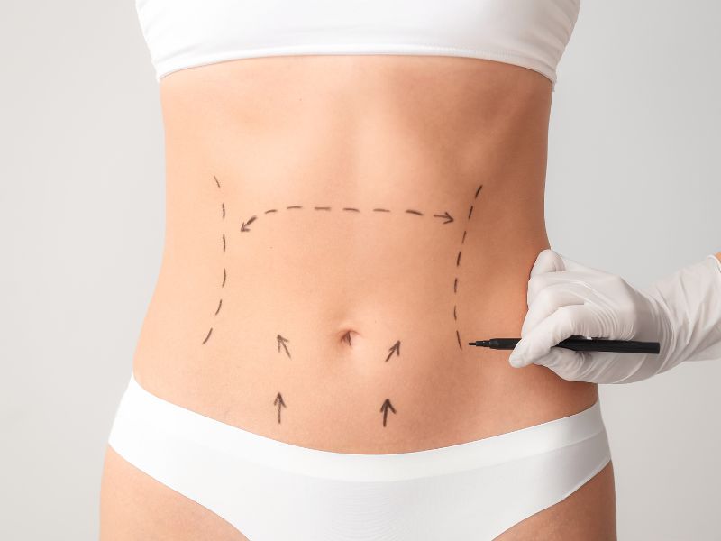 o que é abdominoplastia e cuidados