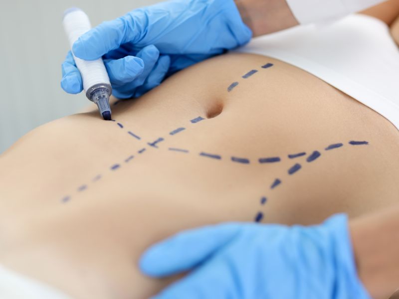 o que é abdominoplastia e como funciona