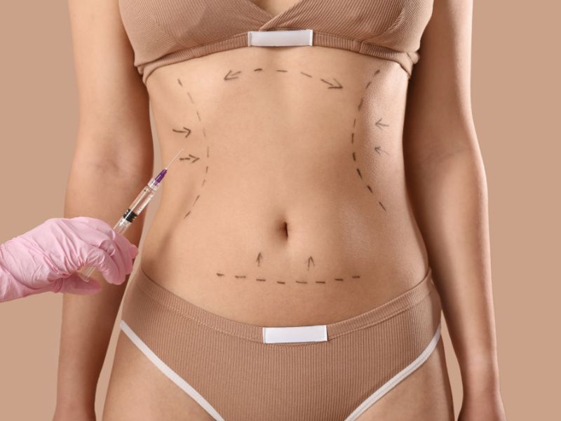 quem fez abdominoplastia pode fazer agachamento - precauções