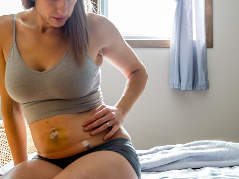 quem fez abdominoplastia pode fazer agachamento - processo
