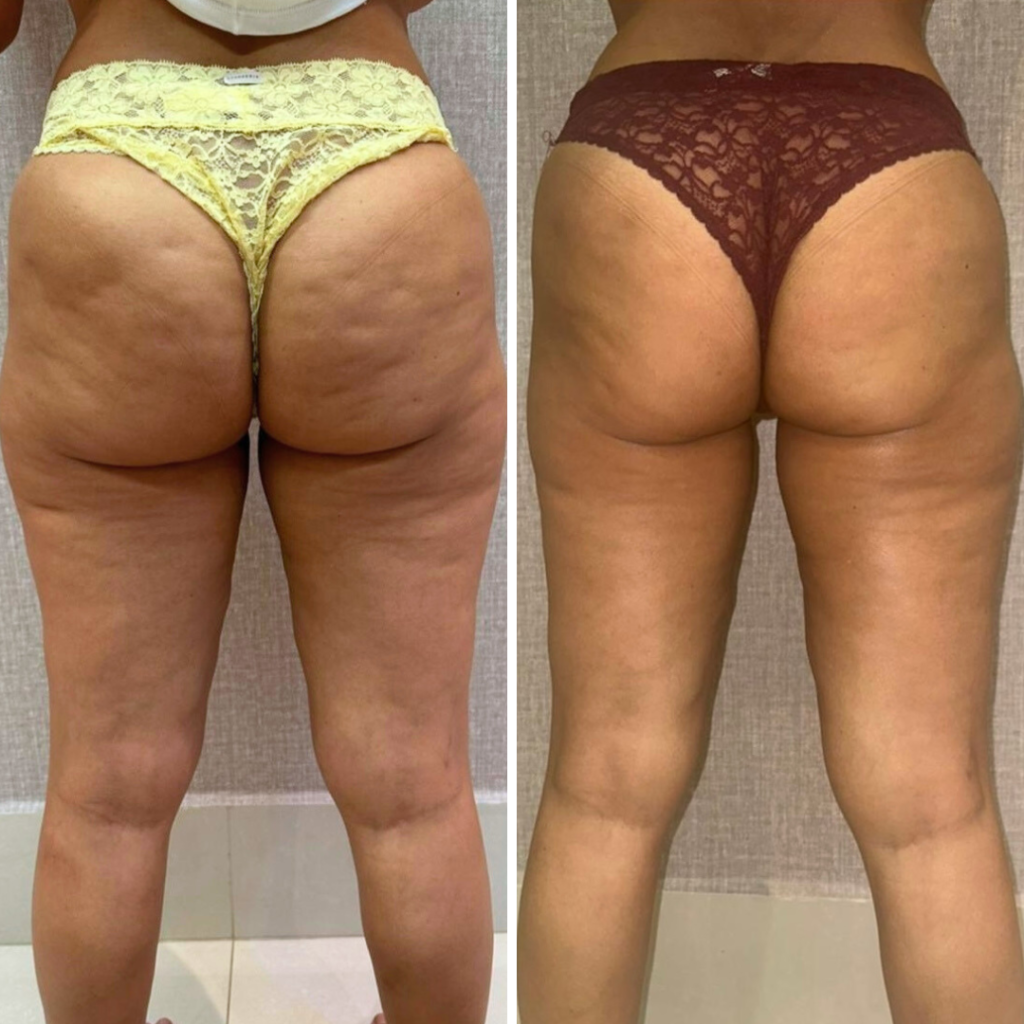 tratamento legacy antes e depois resultados