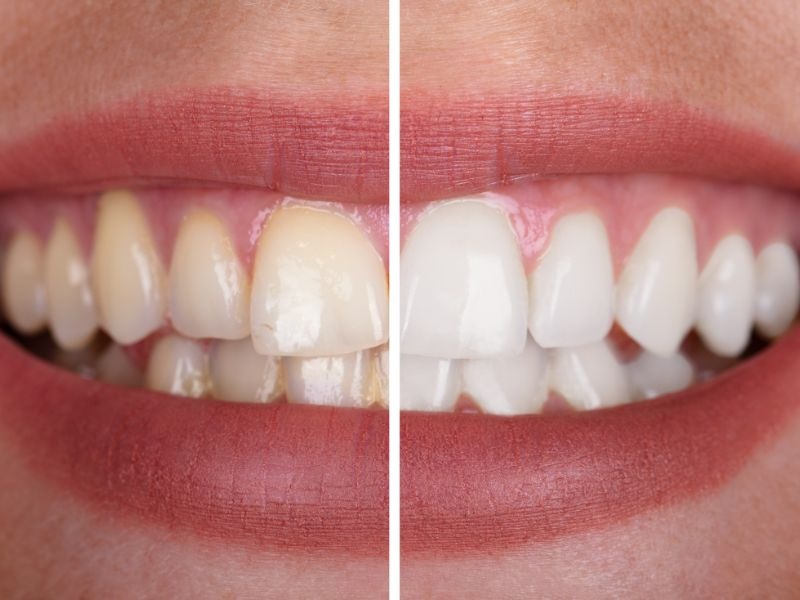 propaganda dentista antes e depois