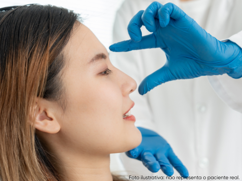 com quantos anos pode fazer rinoplastia feminina sem medo