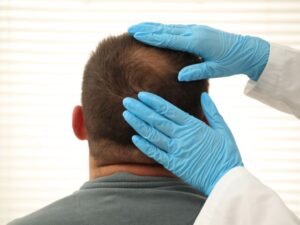 o que é bom para calvície masculina