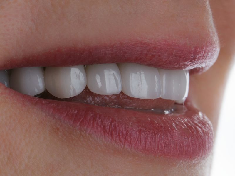 quanto custa lente de contato nos dentes - o que influencia