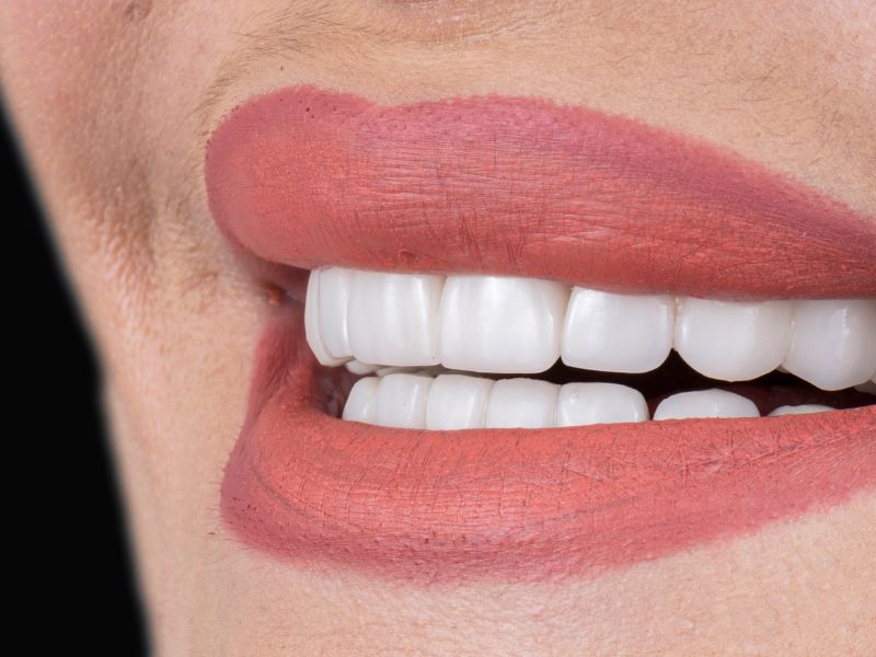 quanto custa lente de contato nos dentes - complexidade