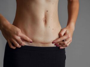 como fica a cicatriz da abdominoplastia