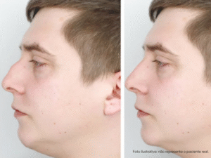nariz torto antes e depois