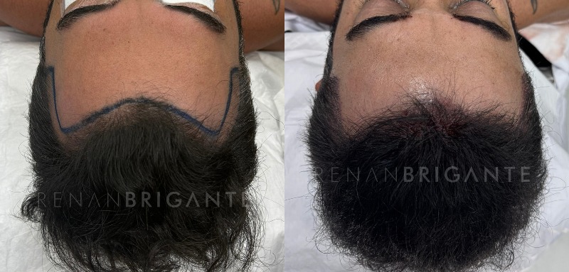 antes e depois do transplante capilar como fica