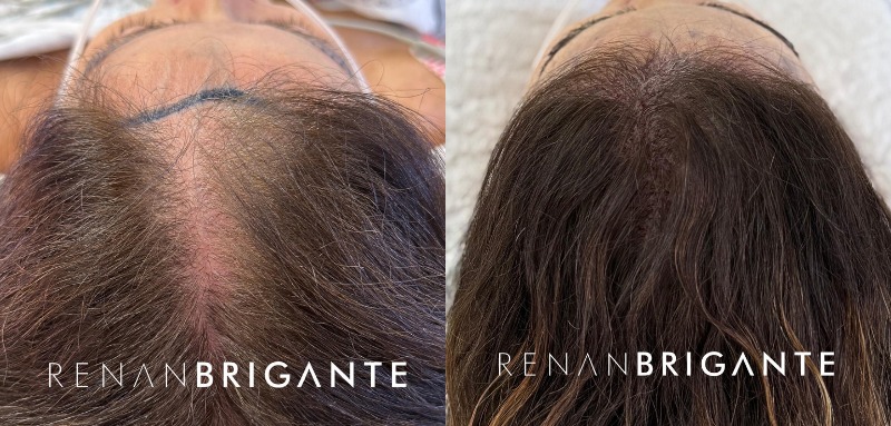 antes e depois do transplante capilar feminino