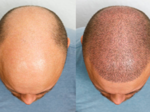 antes e depois do transplante capilar