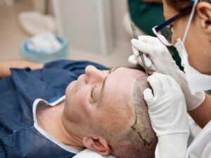 tipos de transplante capilar
