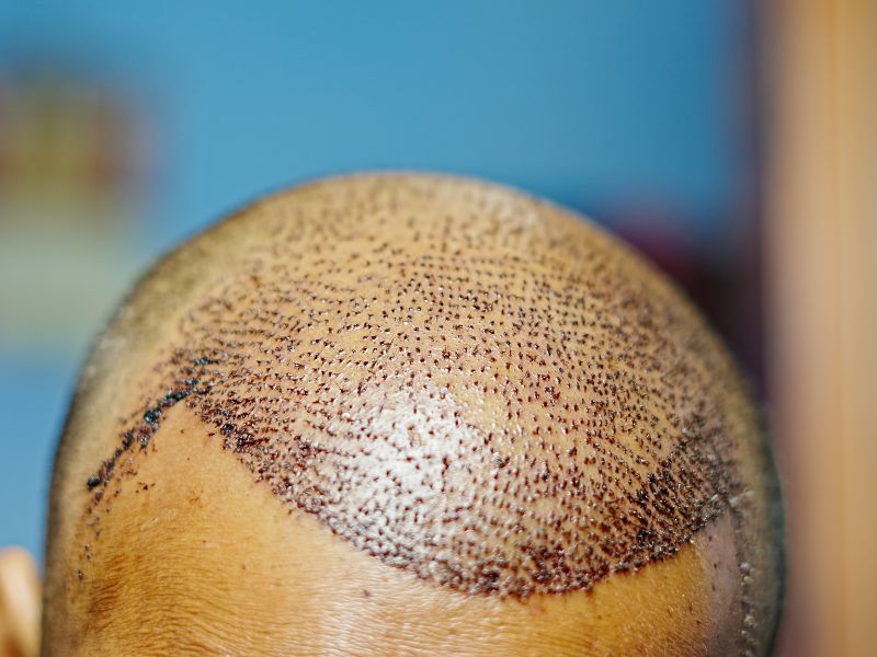 tipos de transplante capilar procedimento