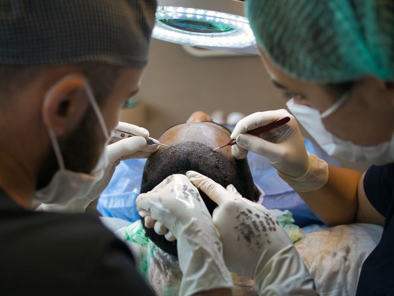 tipos de transplante capilar técnicas