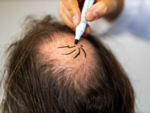 transplante capilar sem raspar o cabelo