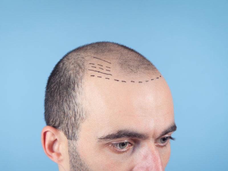 transplante capilar sem raspar o cabelo feminino