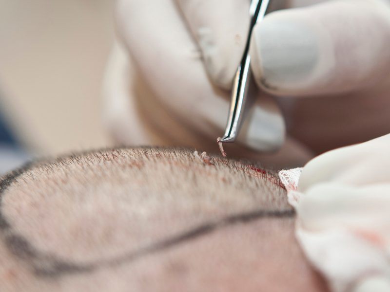 transplante capilar sem raspar o cabelo masculino